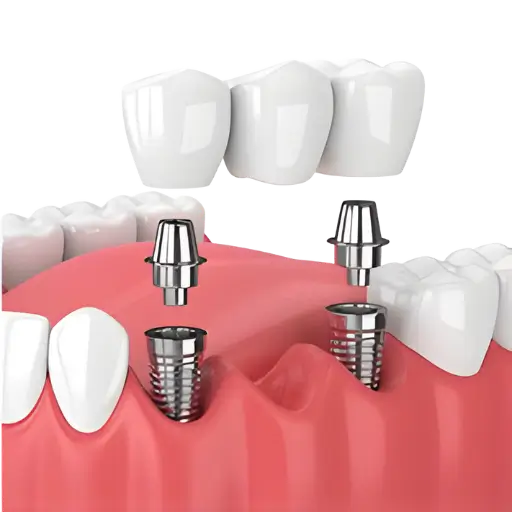 dental bridge