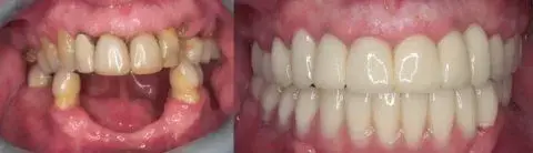 new before and after teeth 480x247