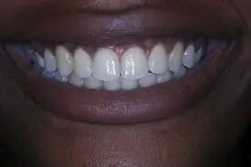 cosmetic crown after