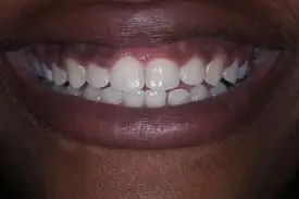 cosmetic crown before