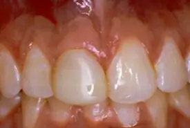 crowns (caps) before 1