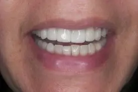 fixed porcelain after 1