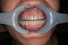 fixed porcelain before 2