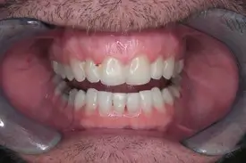 invisalign after 1