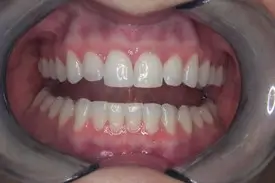invisalign after 2