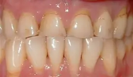 porcelain crowns before 1