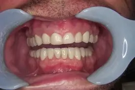 rehabilitation after 1